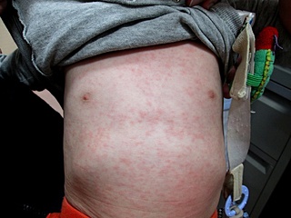 皮膚のぶつぶつ 発疹岡山市南区で小児科・内科なら岡山南区にじいろ内科・小児科クリニック