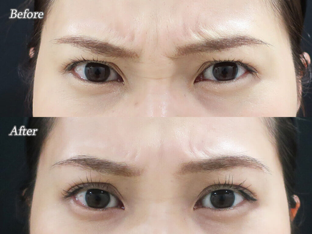 鼻の付け根のシワ👃 バニーラインって言うのですが、 このシワ、結構老けて見えます😮‍💨 私が今1番気になるシワです。 シワは私の地図だけど、あまり深く刻まなくてもいいのに🥲 改善できることしていきたいと思います😊☝️アラフィフ女子アラフォー女子40代女子