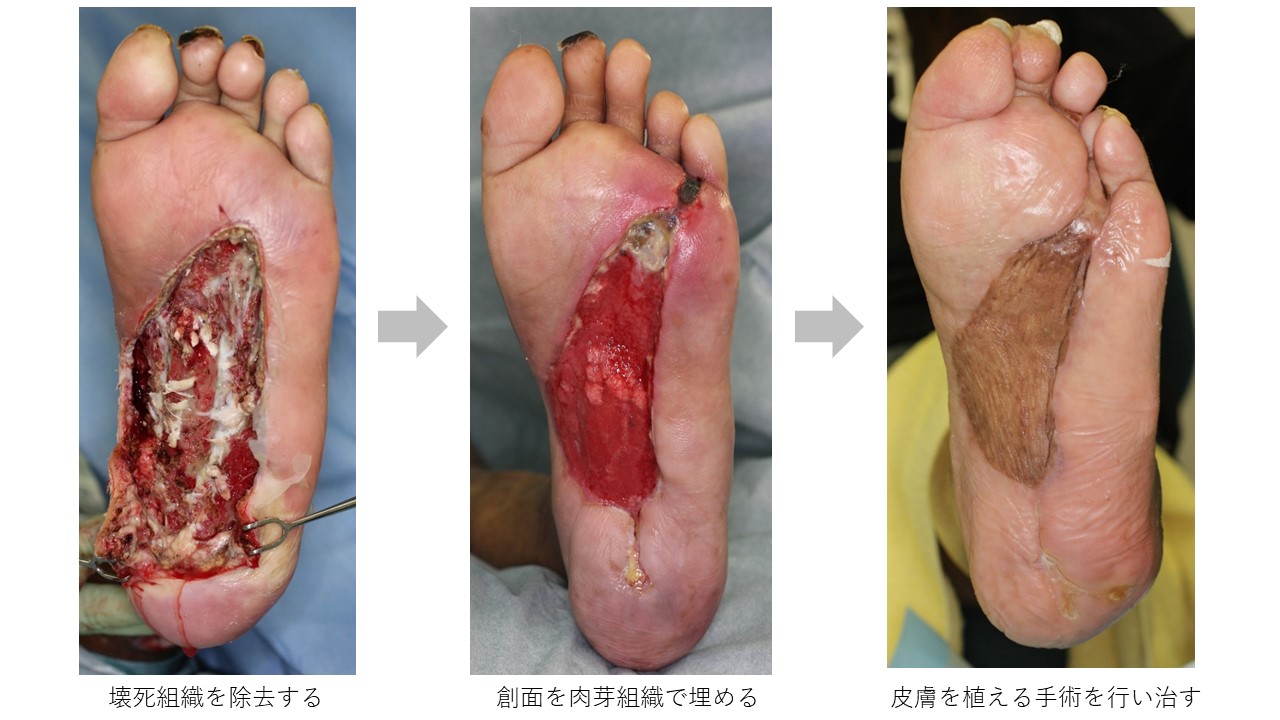 特集記事糖尿病の合併症「皮膚潰瘍」の症状と新しい治療法 写真あり病院口コミ検索カル