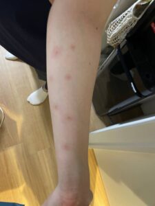 トコジラミに刺されたらどうする？症状や噛み跡の特徴、ダニとの違いを徹底解説 - 害虫駆除・対策のプロ業者害虫獣SOS