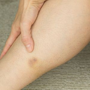 手や足にあざができて消えるなんでも健康相談日本老友新聞