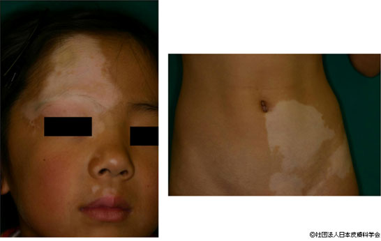 子どもの顔に白い斑点 「はたけ」は保湿がカギSchoowell スクウェル
