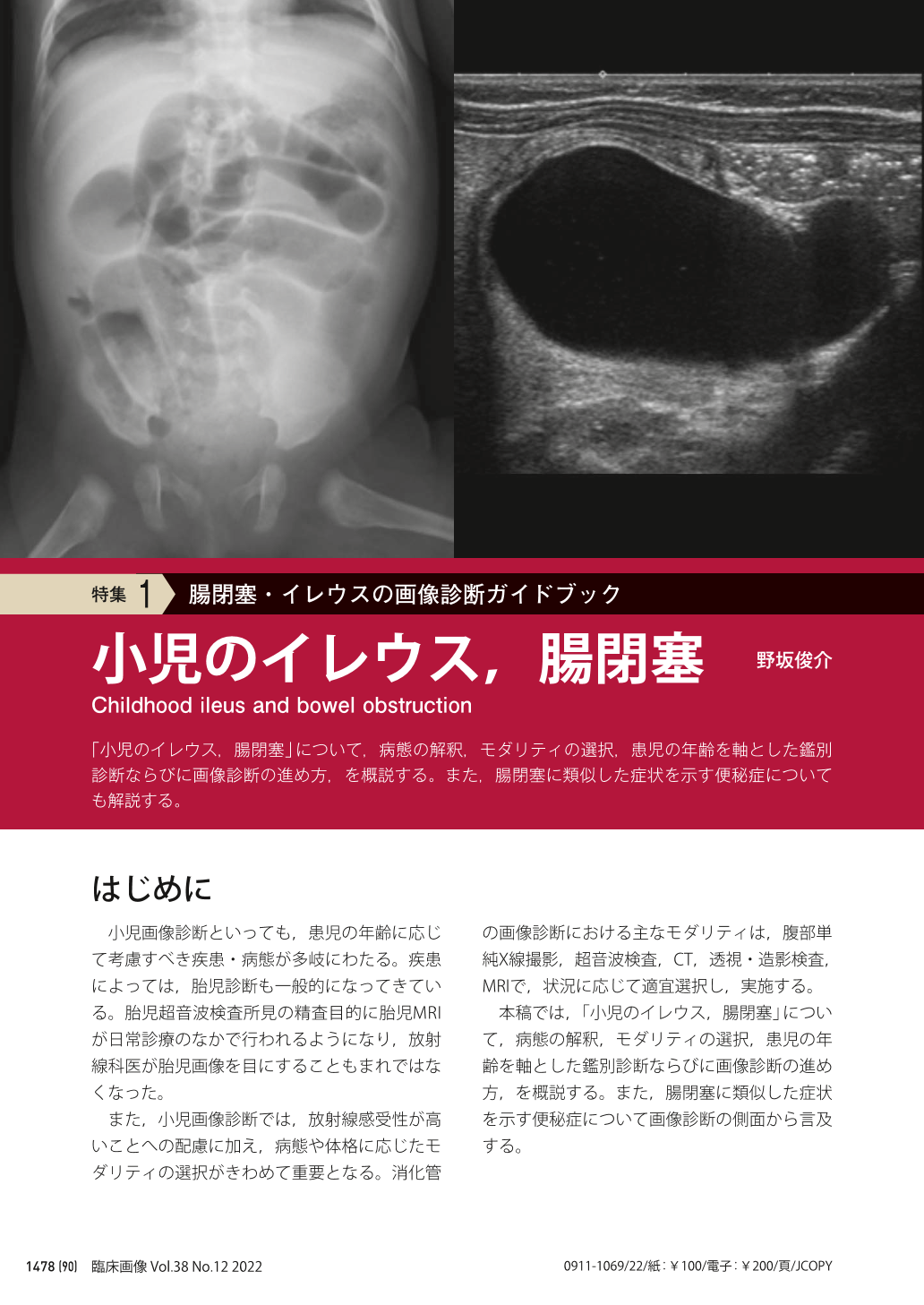 108I23腸閉塞・イレウス 国試テコプラ