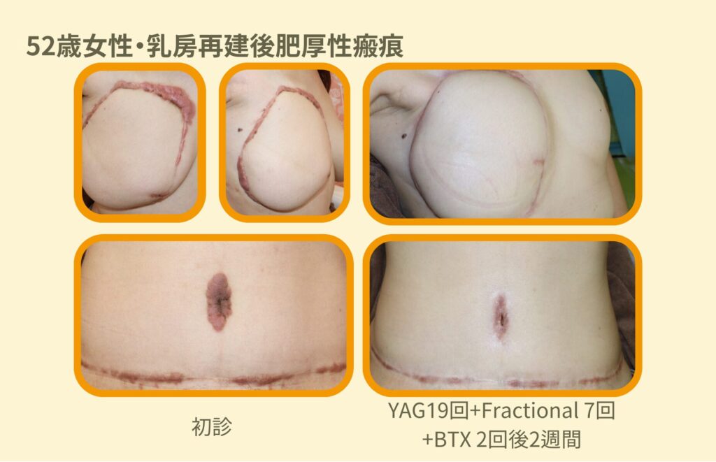 皮膚への乳がん転移はどのように見えるのか ～皮膚に現れる再発の理解～