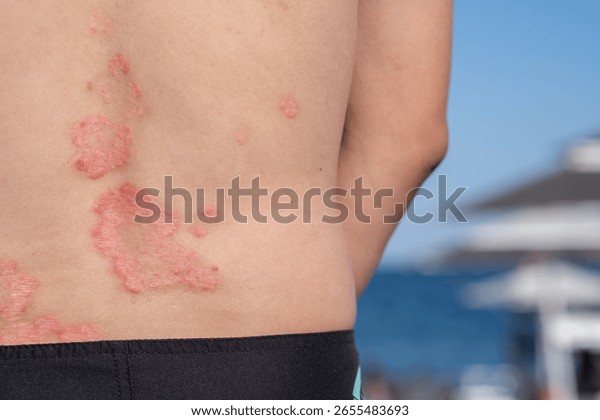 尋常性乾癬吹田市の皮膚科もりはら皮ふ科クリニック